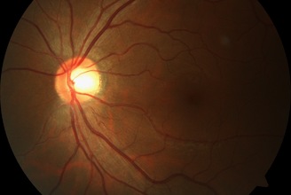 Glaucomatous Optic Neuropathy